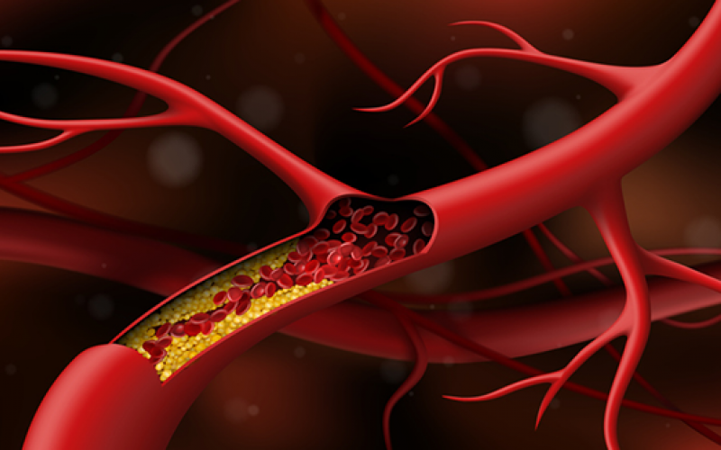 Thrombose